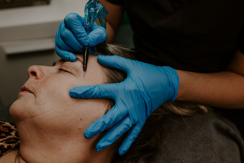 Skin tags near eyes before and after electrolysis skin treatment